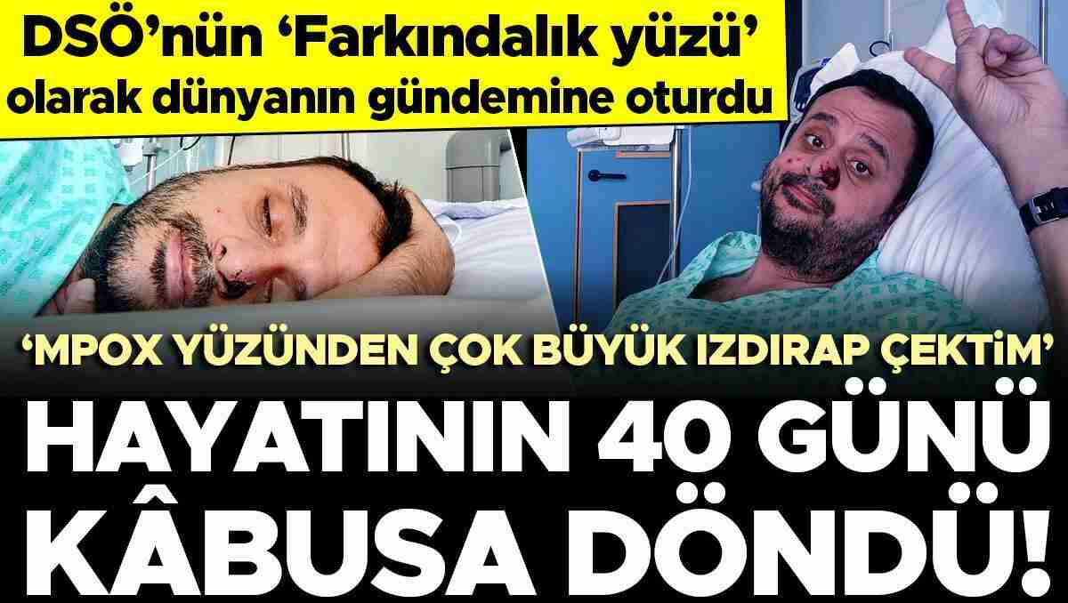 Avrupa'daki ilk hastalardandı... Mpox hastalığına yakalanan Harun Tulunay, yaşadıklarını anlattı: Çok büyük ızdırap çektim Avrupa'daki ilk hastalardandı... Mpox hastalığına yakalanan Harun Tulunay, yaşadıklarını anlattı: Çok büyük ızdırap çektim