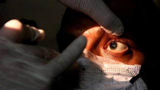 Hızlı yayılan kara mantar hastalığının tedavisi: Bir gözünü çıkartmak!