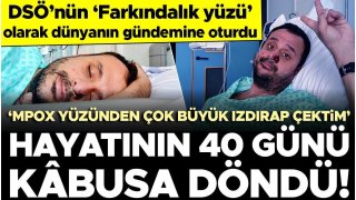 Avrupa'daki ilk hastalardandı... Mpox hastalığına yakalanan Harun Tulunay, yaşadıklarını anlattı: Çok büyük ızdırap çektim